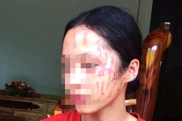 Nữ sinh bị cào rách mặt vì bênh em gái - ảnh 1