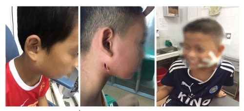 Nghệ An: 3 bệnh nhi mắc bệnh nhiễm "vi khuẩn ăn thịt người", 1 cháu đã được xuất viện - ảnh 1