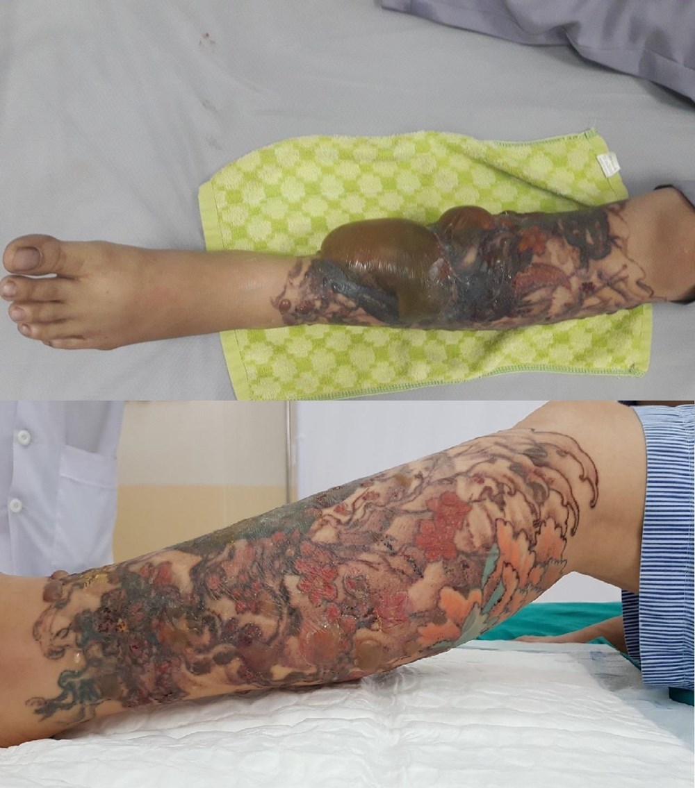 Bỏng cả cẳng chân vì đi xoá vết xăm - ảnh 1