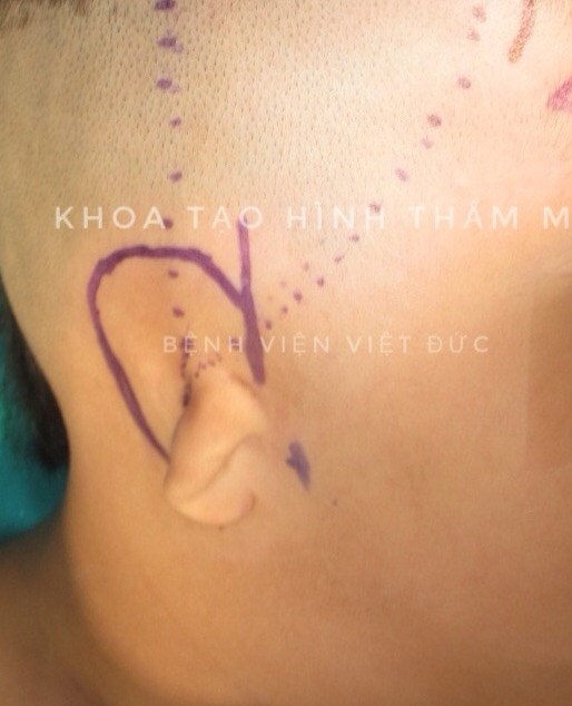 Để trẻ đến trường không bị mặc cảm vì vành tai dị tật - ảnh 1