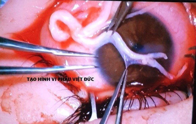 Mất cảm giác giác mạc có thể dẫn đến mù loà - ảnh 2