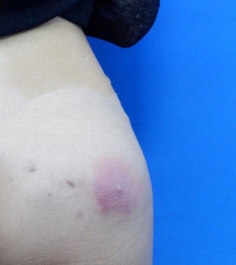 Cô gái bị biến dạng vòng 3 chỉ vì làm đẹp bằng chất không rõ nguồn gốc - ảnh 1