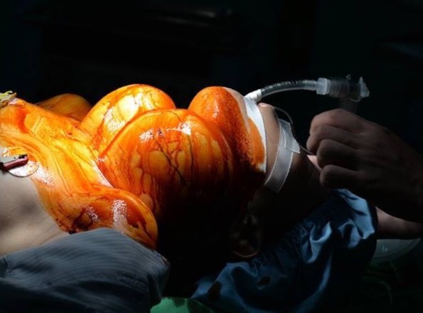 Khối u nặng 4kg vì chủ quan không thăm khám - ảnh 1