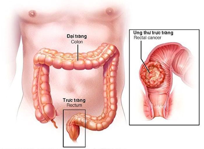 Một gia đình 7 - 8 người ung thư đại tràng - ảnh 1