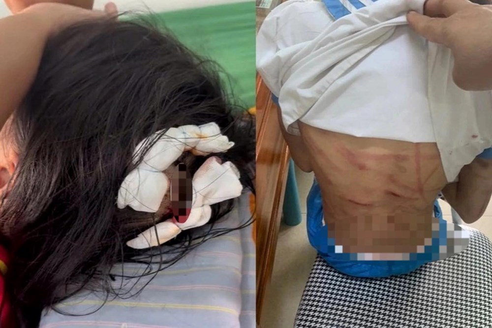 Công an Hà Tĩnh triệu tập cha dượng nghi bạo hành bé gái - ảnh 1