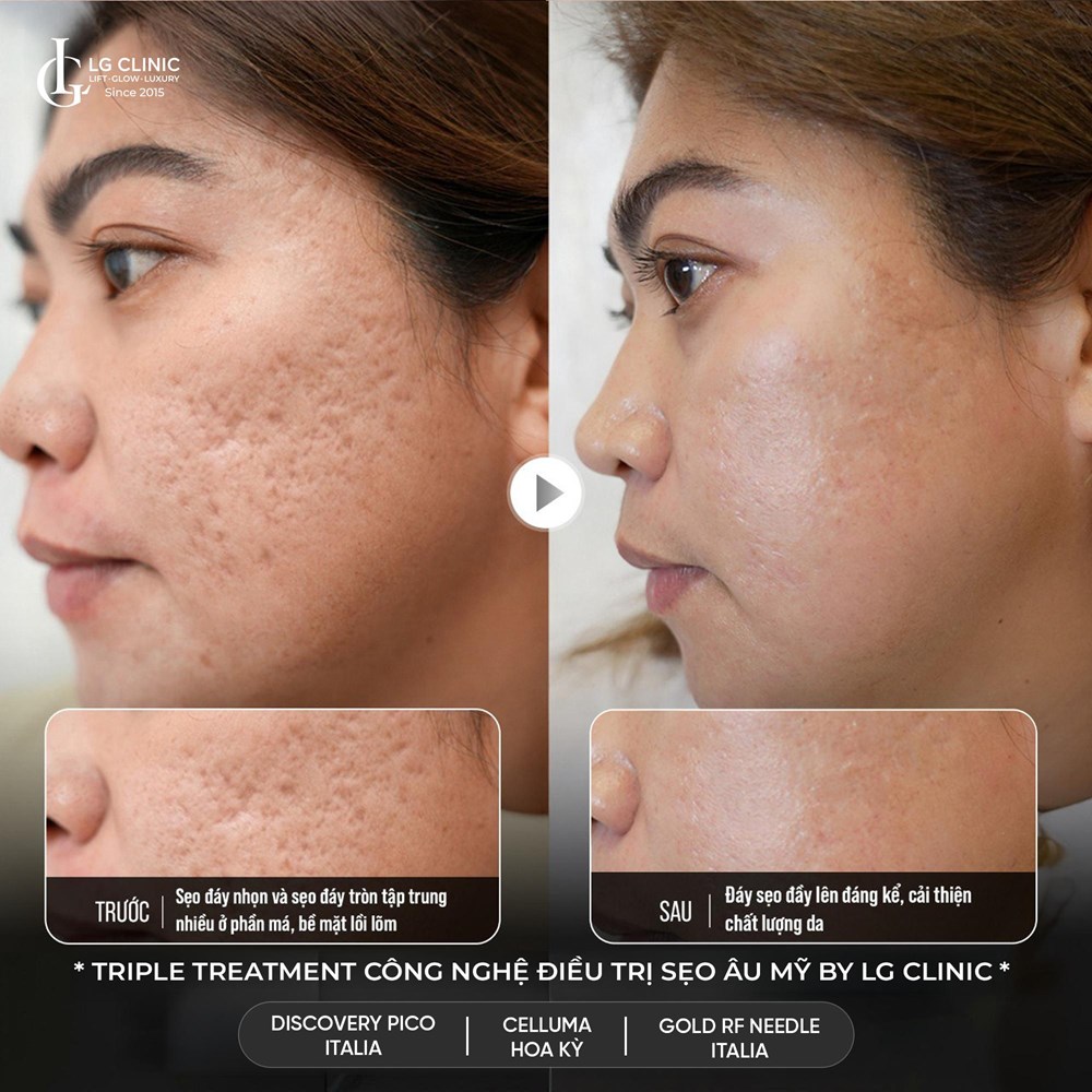 Triple Treatment – Điều trị sẹo rỗ công nghệ hàng đầu Âu Mỹ tại LG Clinic - ảnh 3