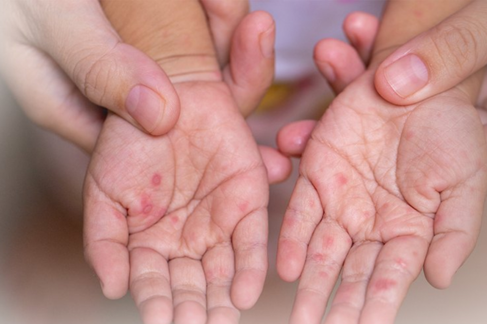 Bộ Y tế cảnh báo nguy cơ bùng phát dịch tay chân miệng và sốt xuất huyết - ảnh 1