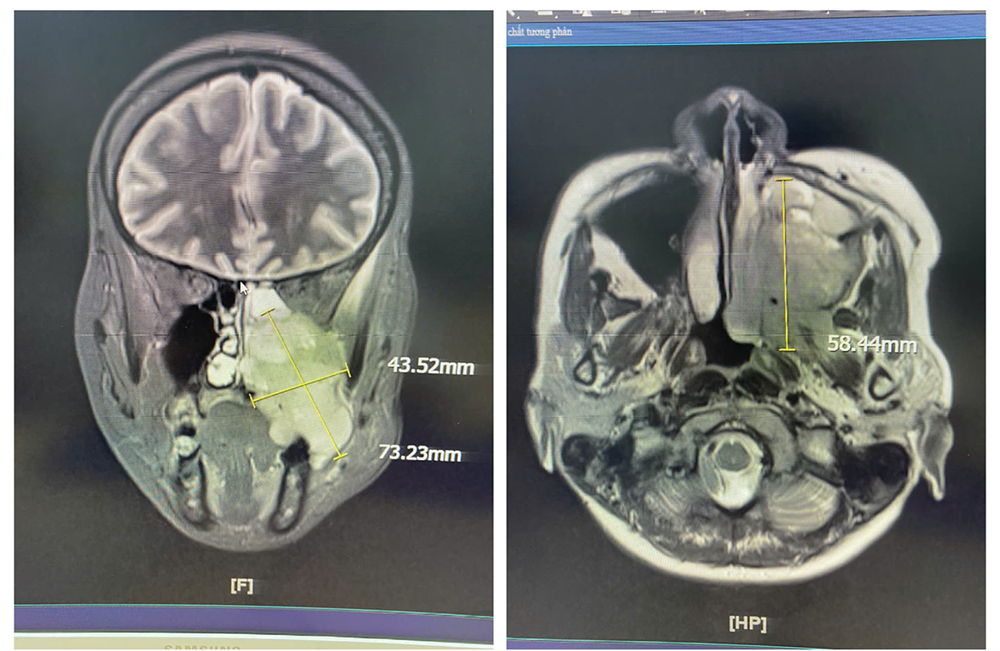 Đừng chủ quan với triệu chứng đau hàm, nghẹt mũi, chảy máu răng kéo dài - ảnh 1