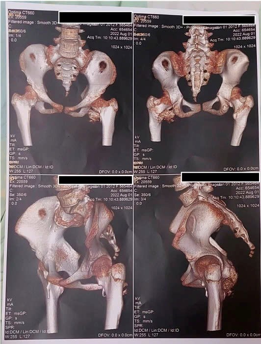 TP.HCM: Phát hiện hội chứng “người hóa đá” thể cực hiếm ở bệnh nhi 12 tuổi  - ảnh 1