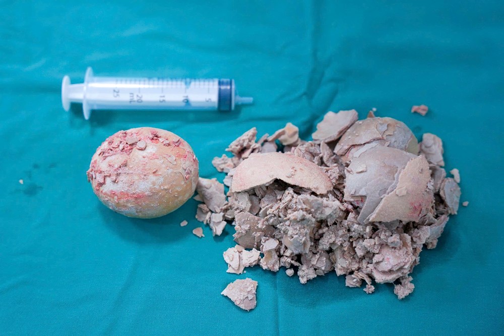 Bệnh viện Hùng Vương Gia Lai phẫu thuật thành công sỏi bàng quang “khổng lồ” hơn 10cm - ảnh 3