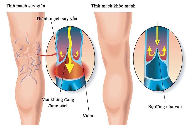 Bệnh suy tĩnh mạch mạn tính nguy hiểm thế nào? - ảnh 1