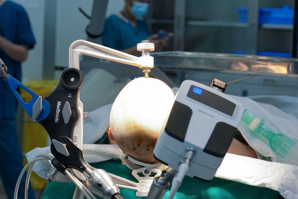 Robot AutoGuide lần đầu xuất hiện tại Việt Nam: Bước ngoặt công nghệ trong điều trị động kinh - ảnh 1