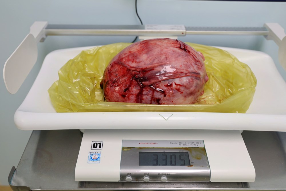 Phú Thọ: Cứu sống bệnh nhân mang khối u xơ tử cung “khổng lồ” - ảnh 2