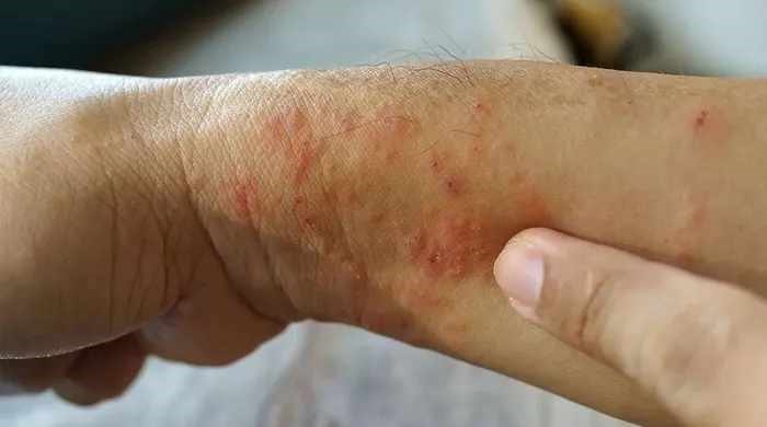 Bộ Y tế cảnh báo về bệnh “sốt đất” khiến 732 ca nhiễm, 23 trường hợp tử vong tại Thái Lan - ảnh 2