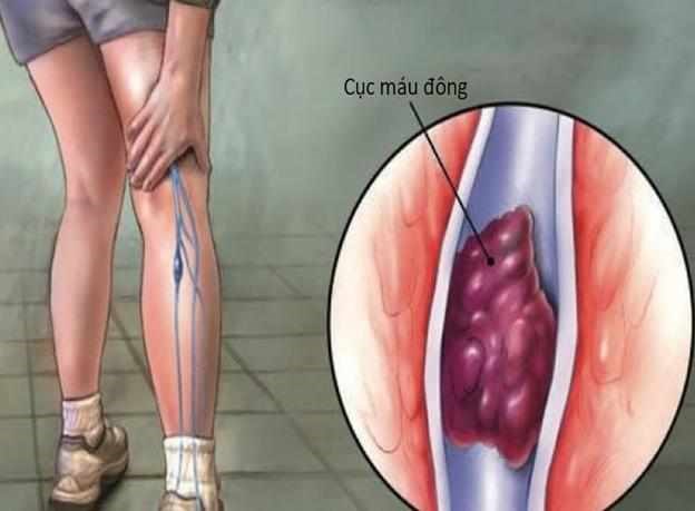 Kiễng chân giúp phòng ngừa huyết khối: Danh y xác nhận là thật, thêm 2 động tác khác cũng hiệu quả - ảnh 1