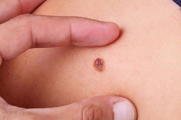 Di căn nhanh, tỉ lệ tử vong cao! Cô gái 25 tuổi qua đời chỉ 5 tháng sau khi chẩn đoán ung thư, bác sĩ đưa ra lời cảnh báo hệ trọng - ảnh 3