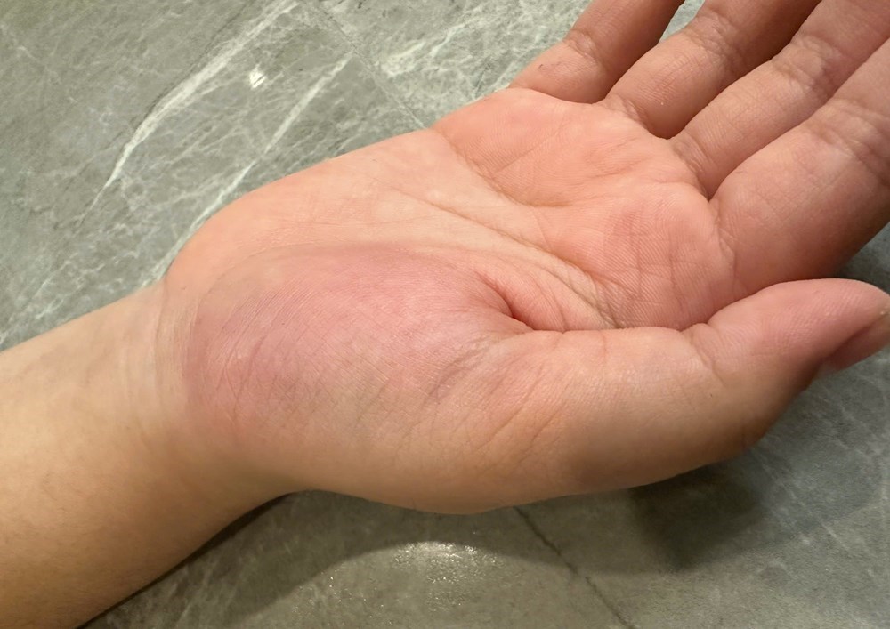 Bệnh viện chứng nhận thương tích của học sinh lớp 4 bị cô giáo đánh vào tay - ảnh 2