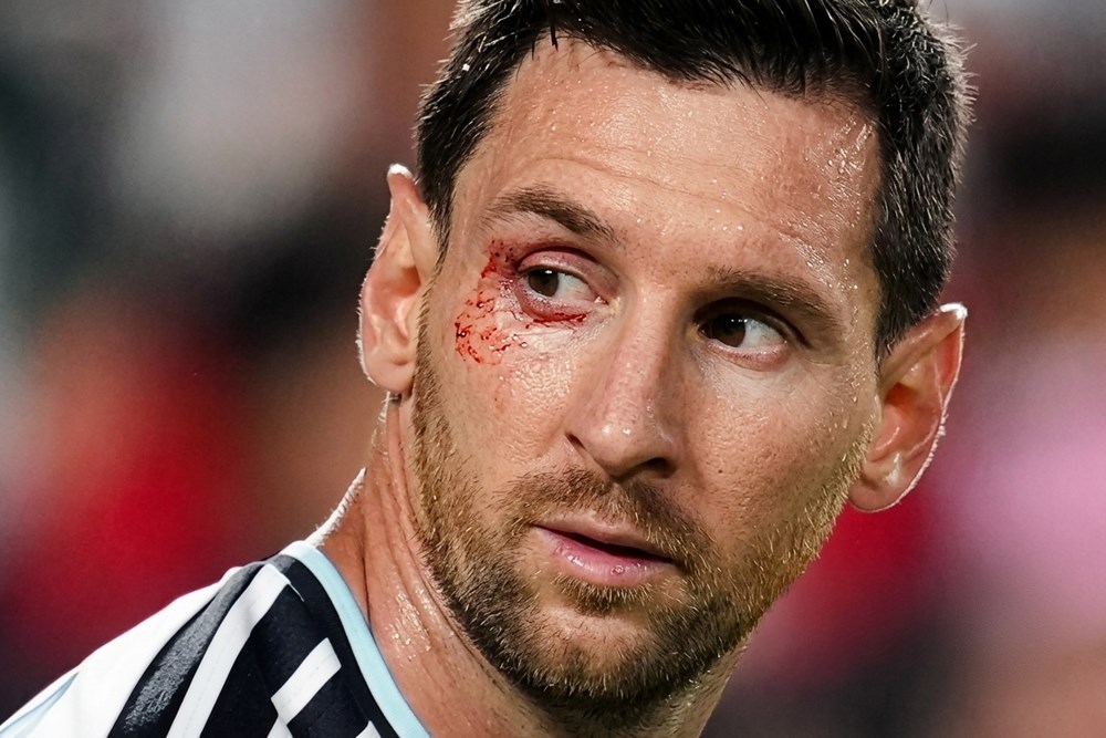 Messi rách mí mắt vì khuỷu tay Xhaka, vẫn chiến đấu đưa Argentina vào bán kết - ảnh 1