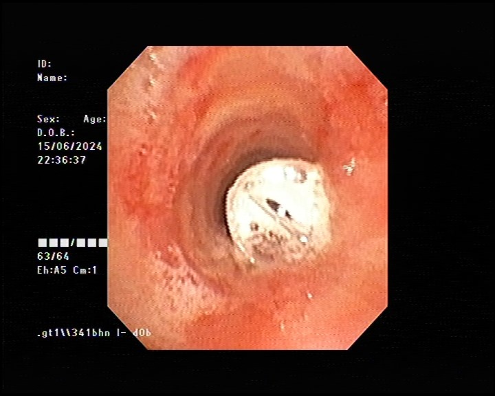 Cứu sống bé 7 tuổi mắc dị vật đường thở - ảnh 1