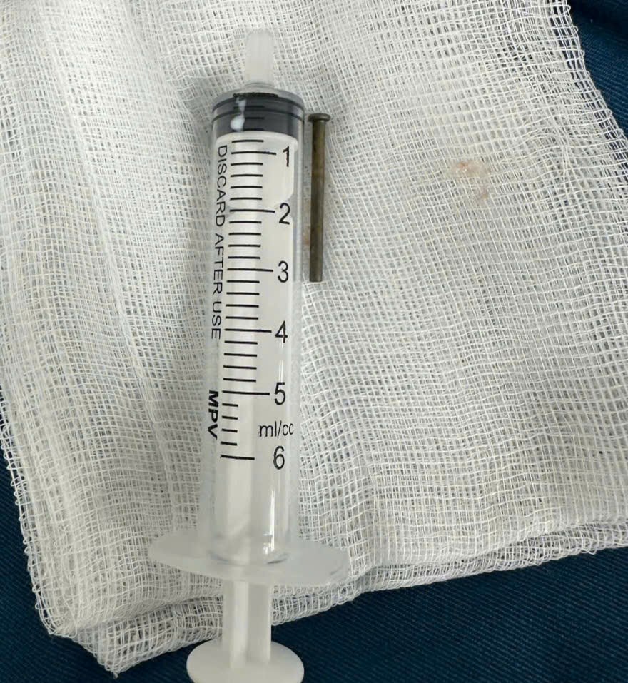 Gắp đinh sắt trong dạ dày bé trai - ảnh 2