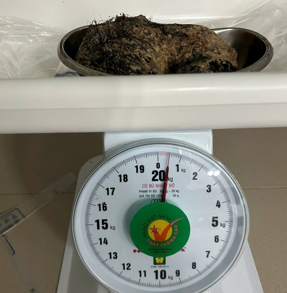 Hi hữu bé gái 6 tuổi ở Quảng Ngãi mang búi tóc 0,5 kg trong dạ dày - ảnh 3