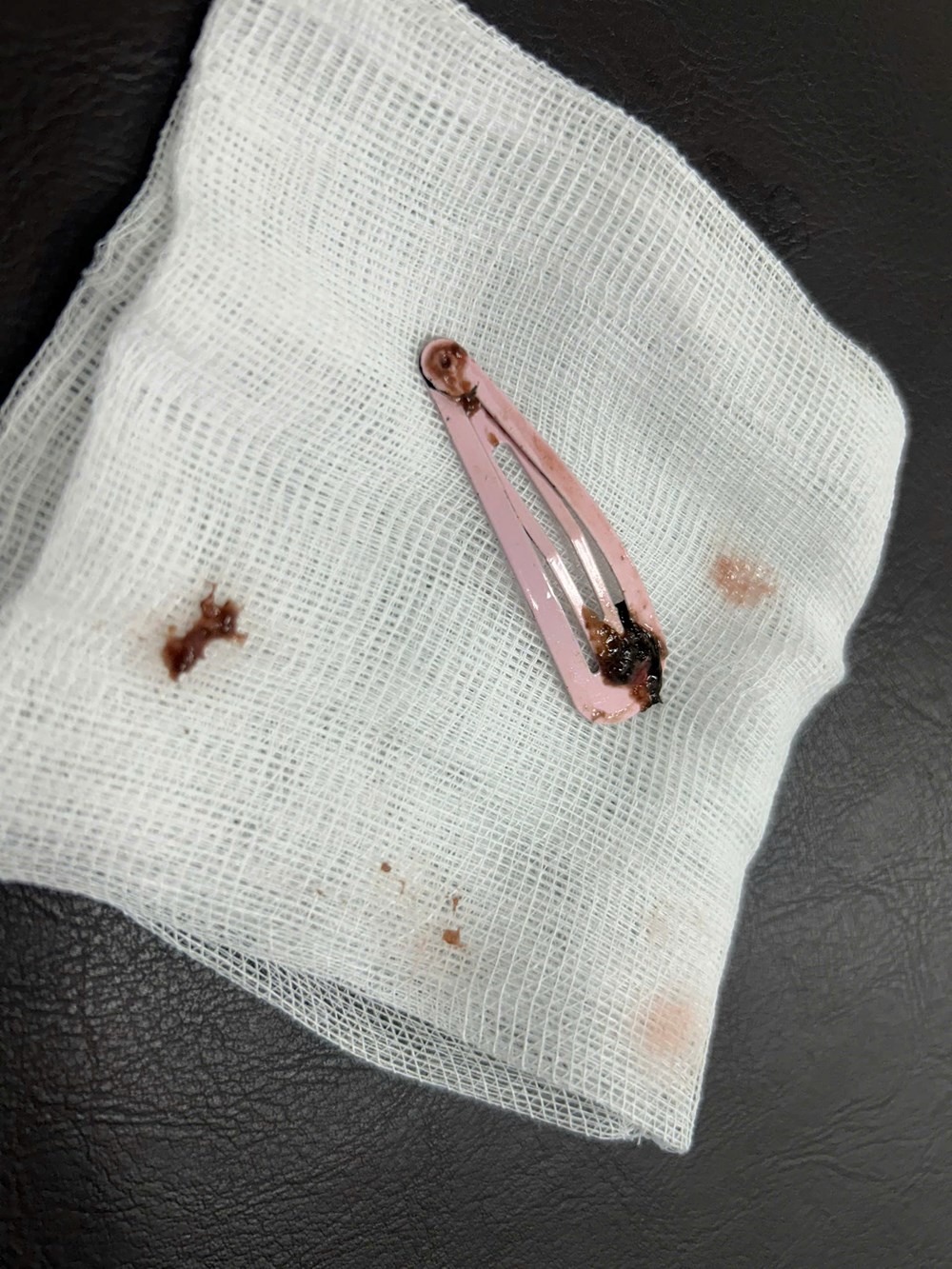 Bé gái 6 tuổi nuốt phải dị vật là kẹp tóc bằng kim loại - ảnh 3