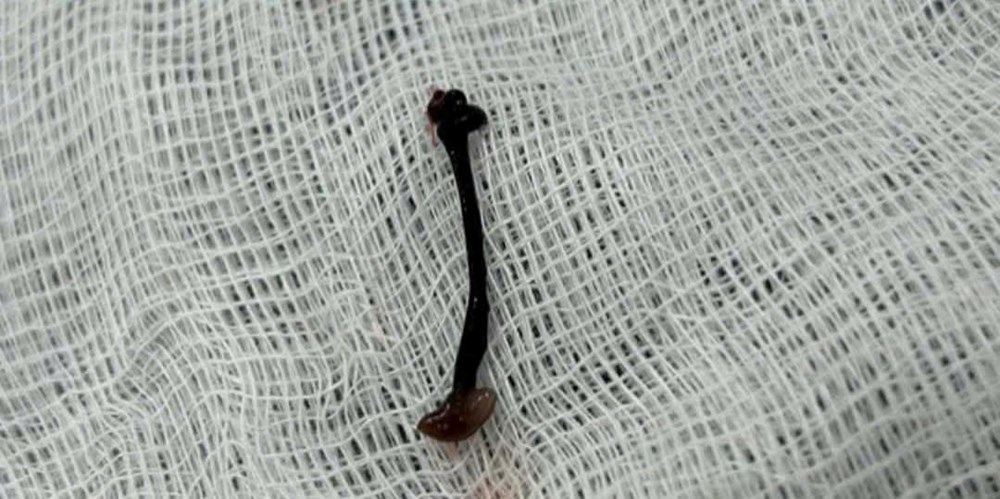 Gắp con vắt suối sống ký sinh trong mũi bé trai 2,5 tuổi - ảnh 3