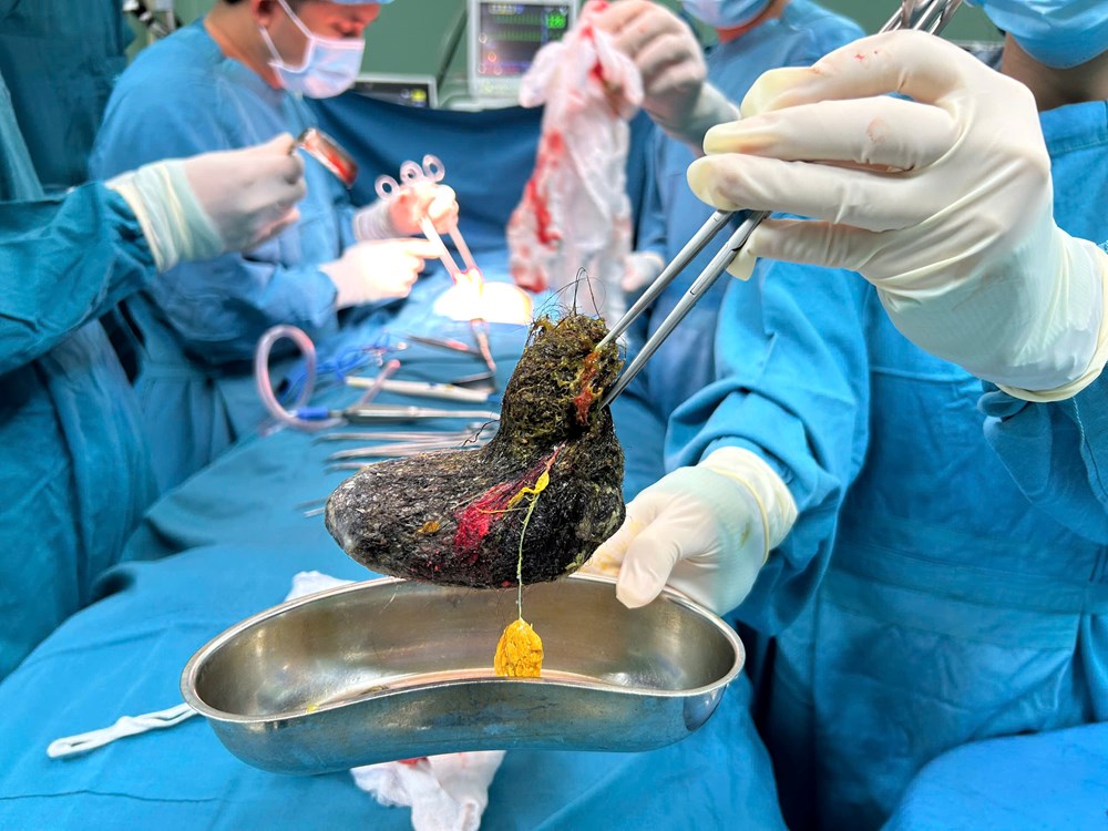 Phẫu thuật thành công ca “Hội chứng Rapunzel” hiếm gặp tại Quảng Ngãi - ảnh 1