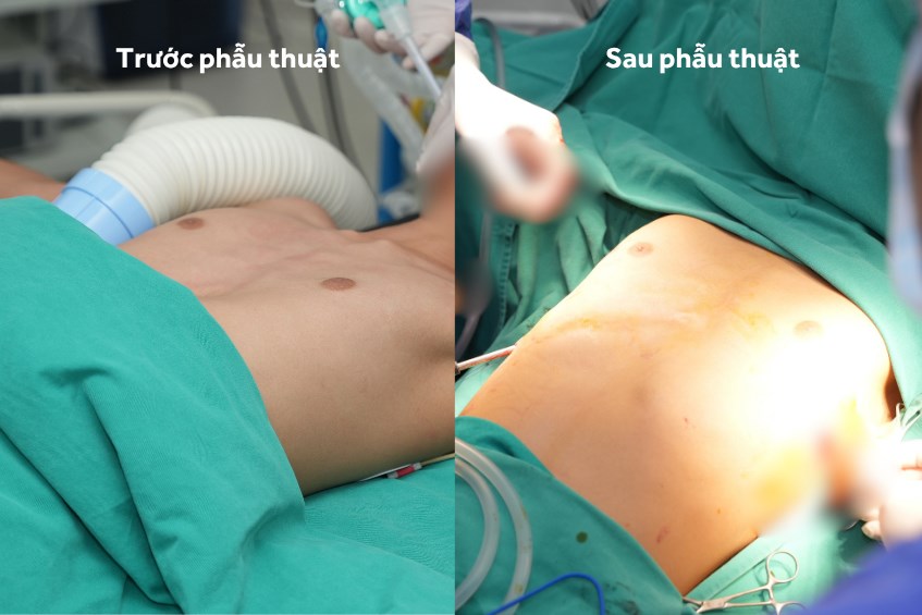 Vinmec Hải Phòng “hồi sinh” lồng ngực bị lõm cho cậu bé 13 tuổi bằng ca phẫu thuật tạo hình phức tạp  - ảnh 2