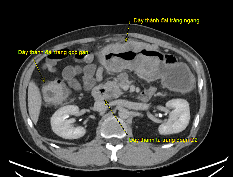 Ca đại phẫu kéo dài hơn 8 giờ giải cứu bệnh nhân mắc ung thư kép - ảnh 2