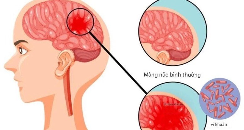 Bệnh não mô cầu xuất hiện trong trường học: Những dấu hiệu phụ huynh không thể bỏ qua - ảnh 1