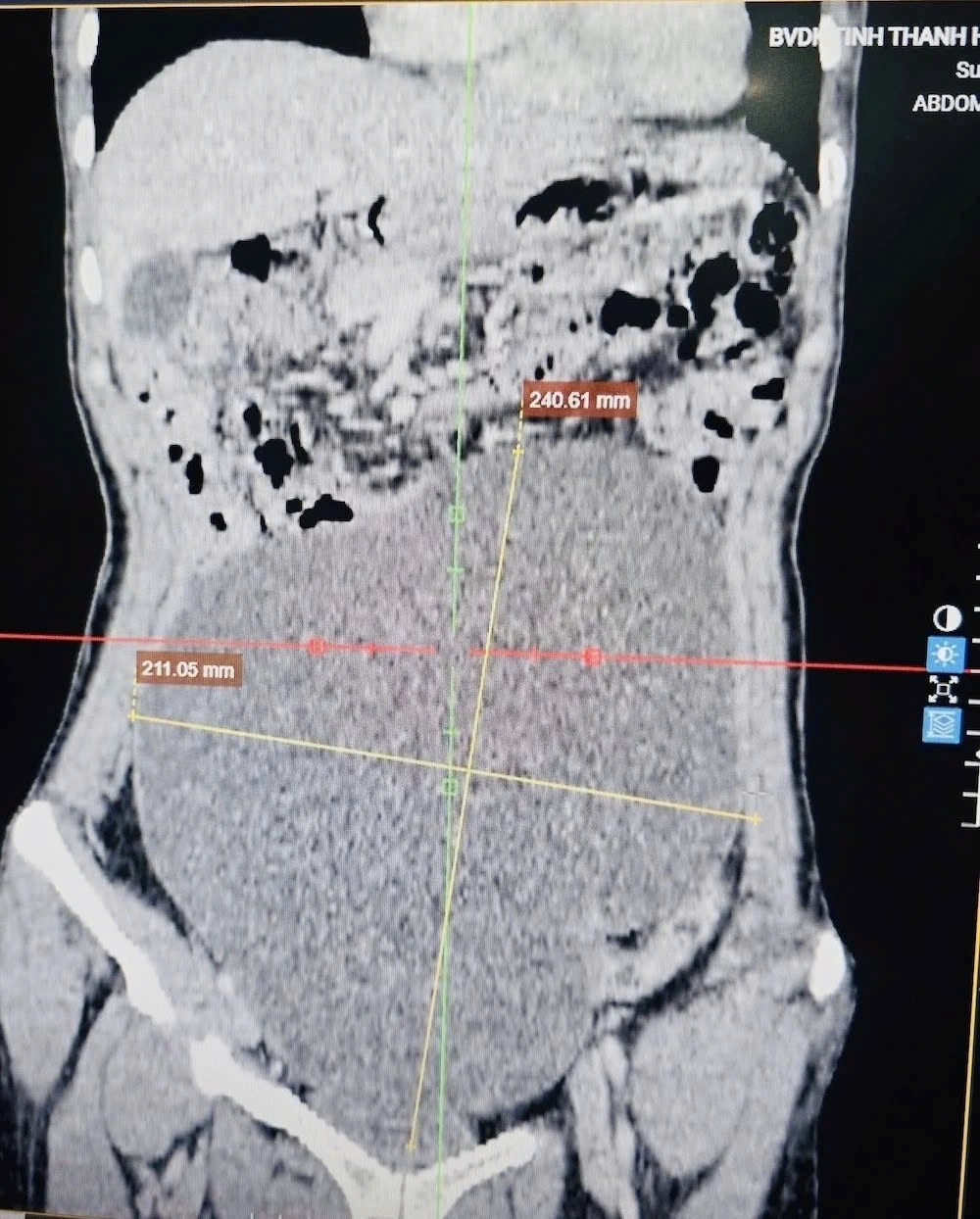 Cắt bỏ khối u buồng trứng gần 3 kg, cứu nữ bệnh nhân đau đớn suốt nhiều năm - ảnh 1