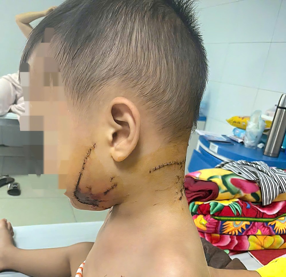 Bé trai nguy kịch vì bị chó nhà cắn, bác sĩ phát cảnh báo khẩn đến các gia đình - ảnh 1