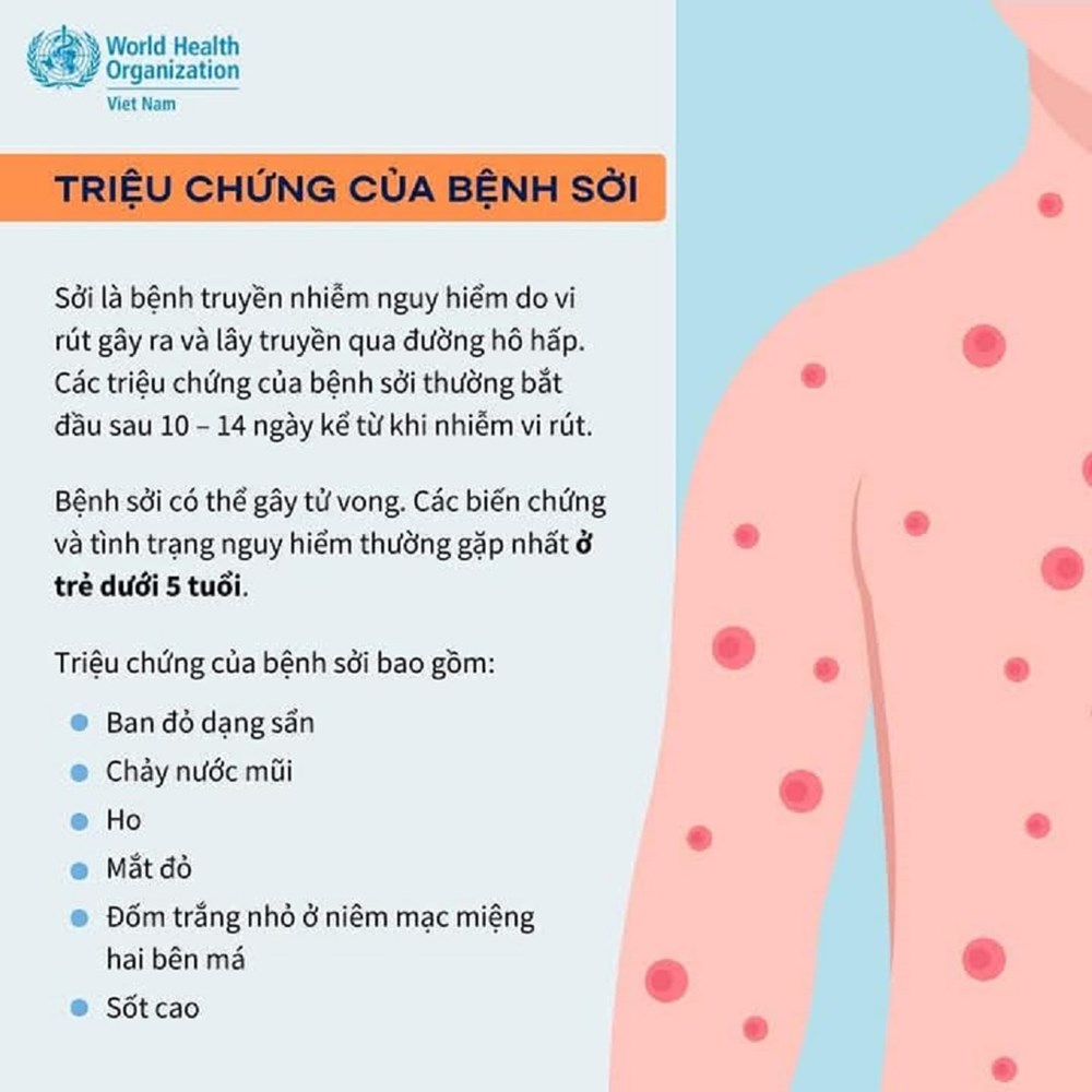 Nghệ An: Gần 1.100 ca sốt phát ban nghi sởi, nguy cơ bùng phát dịch - ảnh 1