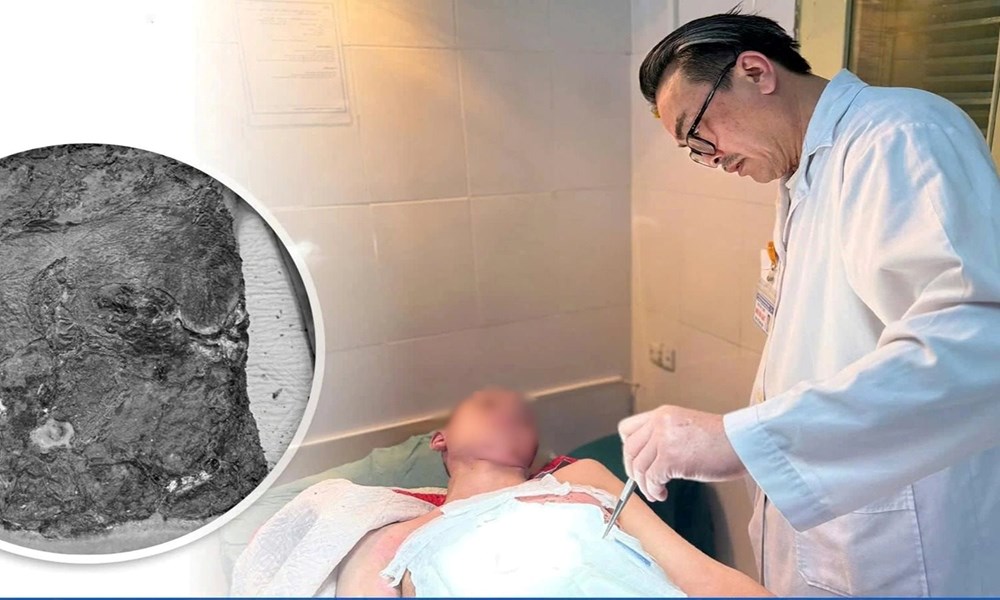 Nam sinh nhiễm trùng nặng do điều trị bỏng bằng thuốc nam tại nhà - ảnh 1