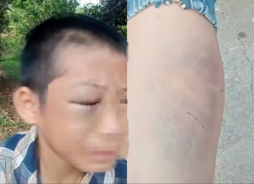 Điều tra vụ việc bé trai lớp 6 nghi bị bố và mẹ kế bạo hành - ảnh 1