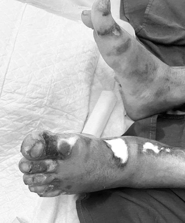 Người đàn ông bị bỏng nặng vì thả diều gần đường dây điện cao thế - ảnh 1