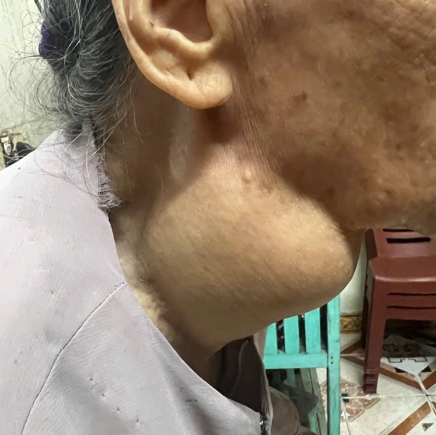 Vinmec Hạ Long giải cứu cụ bà 88 tuổi bị khối u giáp khổng lồ chèn ép đường thở suốt 18 năm - ảnh 1