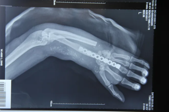 Bác sĩ cứu bàn tay bị đứt lìa của người bệnh bằng cách ghép vào chân - ảnh 3