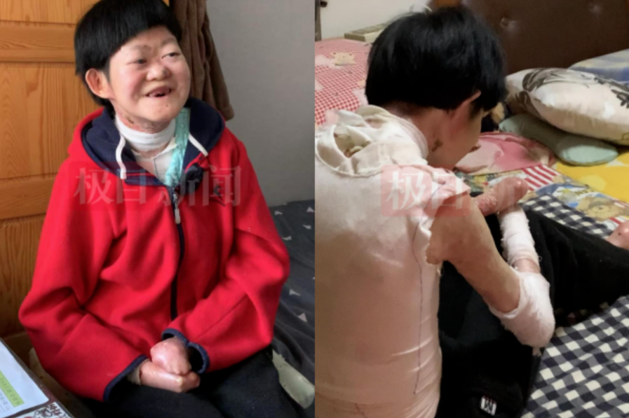 Từng bị chẩn đoán không sống quá 2 tuổi, “cô gái bươm bướm” hiện tại ra sao ở tuổi 25? - ảnh 1