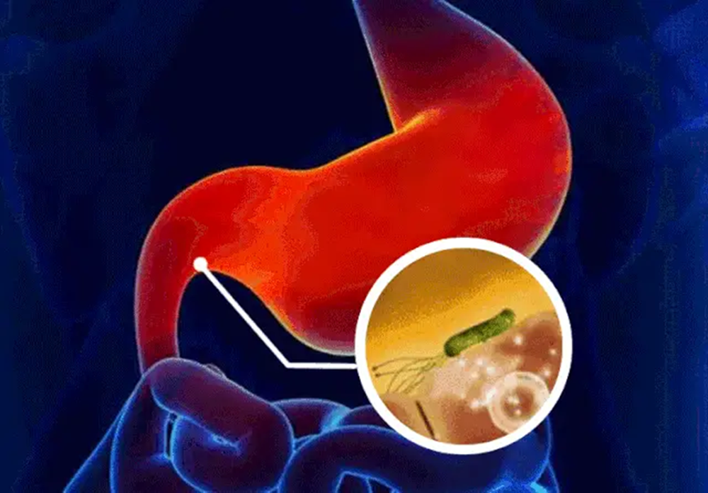 Nghiên cứu sinh tiến sĩ 23 tuổi đã trải qua 10 đợt hóa trị vì ung thư dạ dày giai đoạn cuối: Những dấu hiệu cơ thể không nên xem nhẹ - ảnh 3