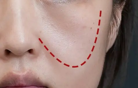 Tránh sai lầm khi chống lão hóa vùng “má hồng“: Đừng vội tiêm chất làm đầy, hãy làm việc này trước để trẻ lại - ảnh 1