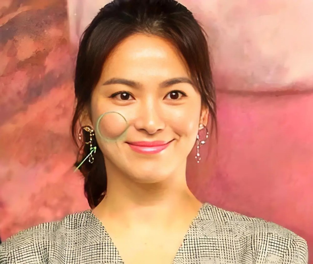 Tránh sai lầm khi chống lão hóa vùng “má hồng“: Đừng vội tiêm chất làm đầy, hãy làm việc này trước để trẻ lại - ảnh 2