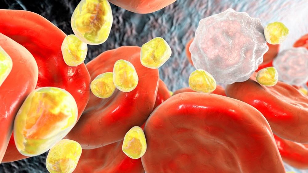 Vì sao tôi luôn kiểm soát mỡ máu nhưng khi khám lại vẫn không cải thiện, thậm chí bị nặng hơn? - ảnh 2