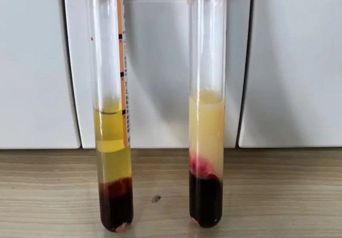 Vì sao tôi luôn kiểm soát mỡ máu nhưng khi khám lại vẫn không cải thiện, thậm chí bị nặng hơn? - ảnh 1