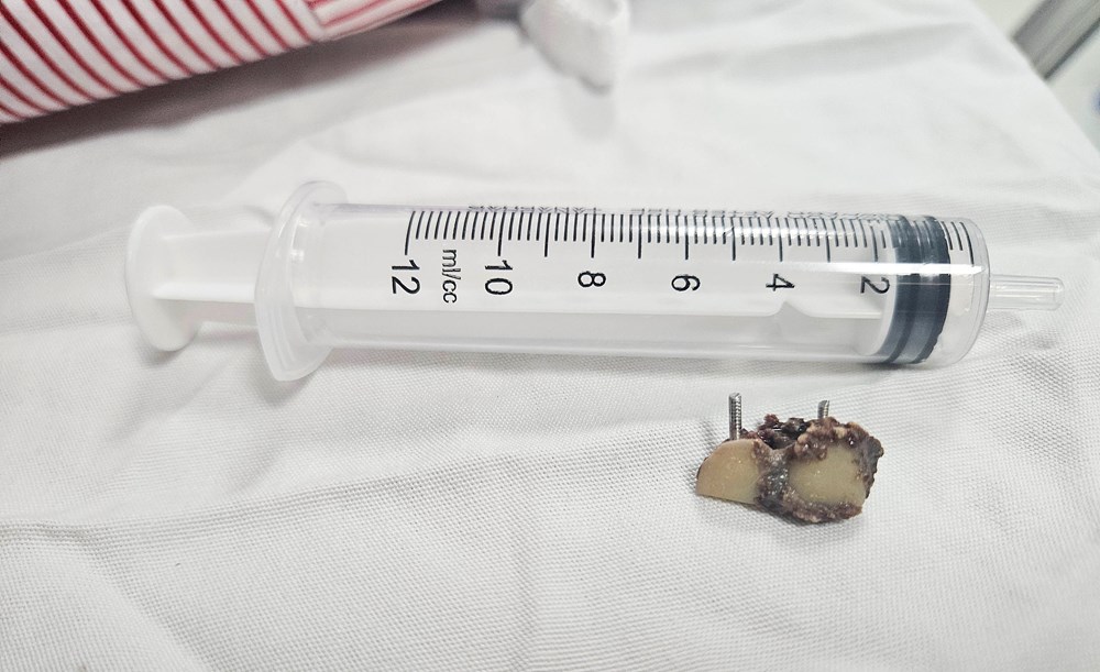 Nội soi phế quản lấy răng giả nằm trong phổi người bệnh hơn 20 năm - ảnh 2