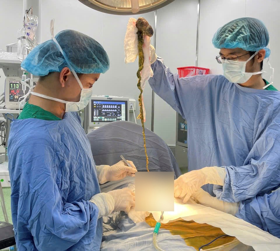 Phẫu thuật lấy búi tóc khổng lồ khỏi dạ dày bé trai 6 tuổi ở Đà Nẵng - ảnh 1