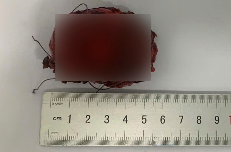 Phẫu thuật liên tiếp 3 ca u ổ bụng ở trẻ nhỏ, cảnh báo nguy cơ phát hiện muộn - ảnh 2