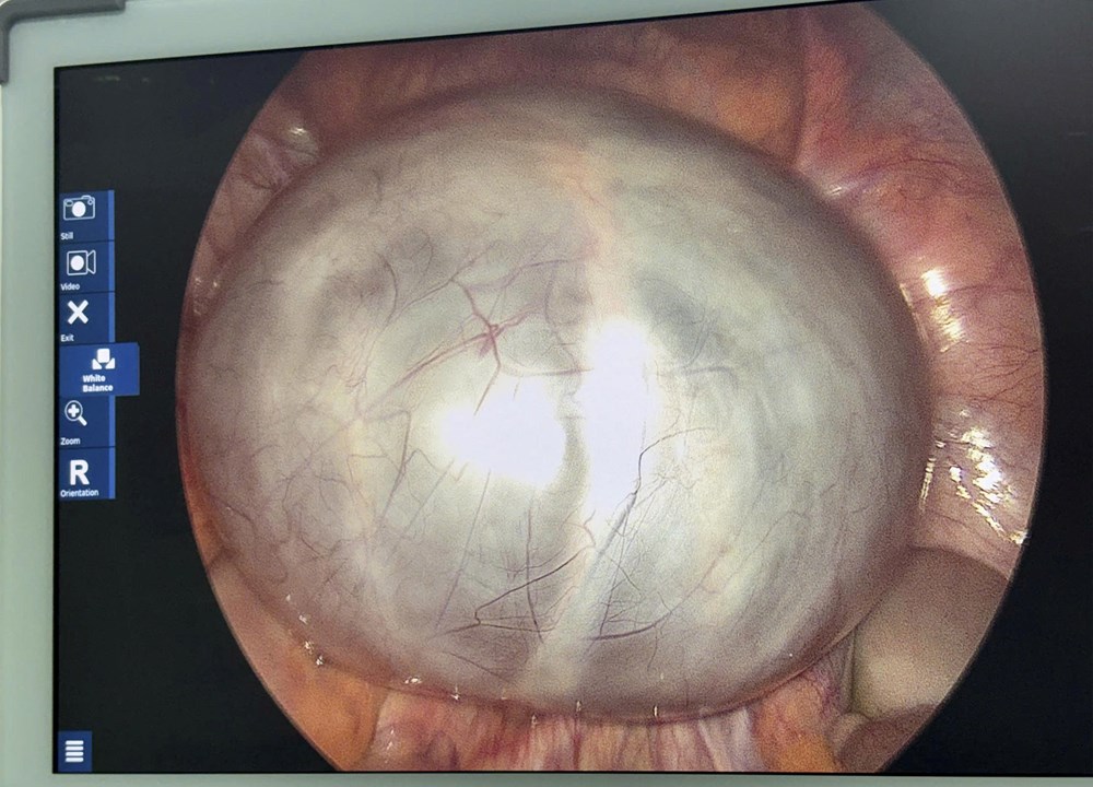 Chủ quan với đau bụng, phát hiện khối u buồng trứng kích thước lớn - ảnh 1