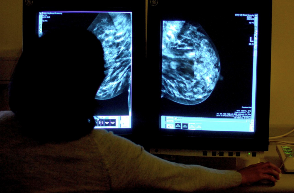 Ung thư vú toàn cầu có thể vượt 3,5 triệu ca mỗi năm vào 2050 - ảnh 1